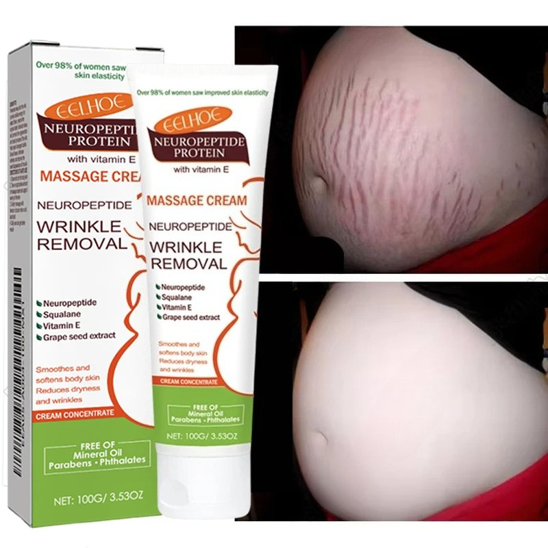 Teeth Whitening Pregnancy - 100g Stretch Marks Permanent Removal Cream