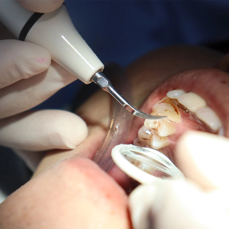 Scaler Handpiece Tube Cable fo - Teeth Whitening Youtube recension och pris