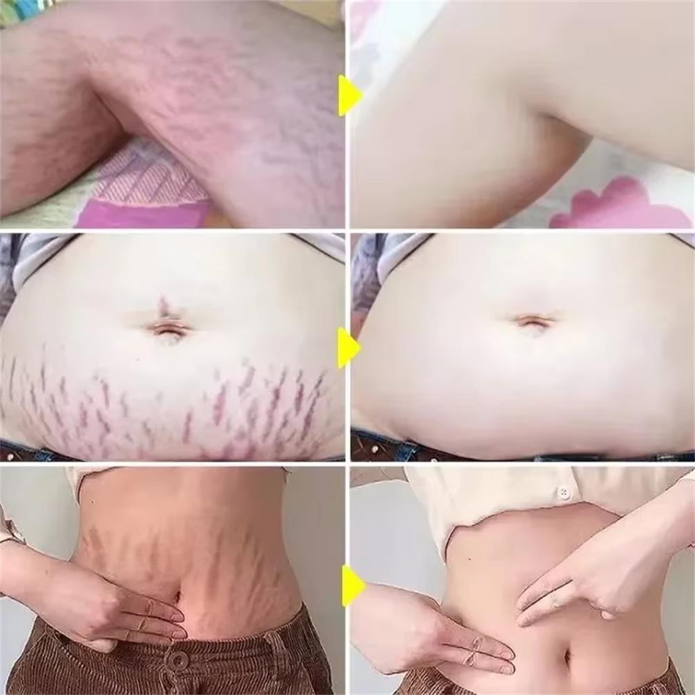 100g Stretch Marks Permanent R - Teeth Whitening Pregnancy recension och pris