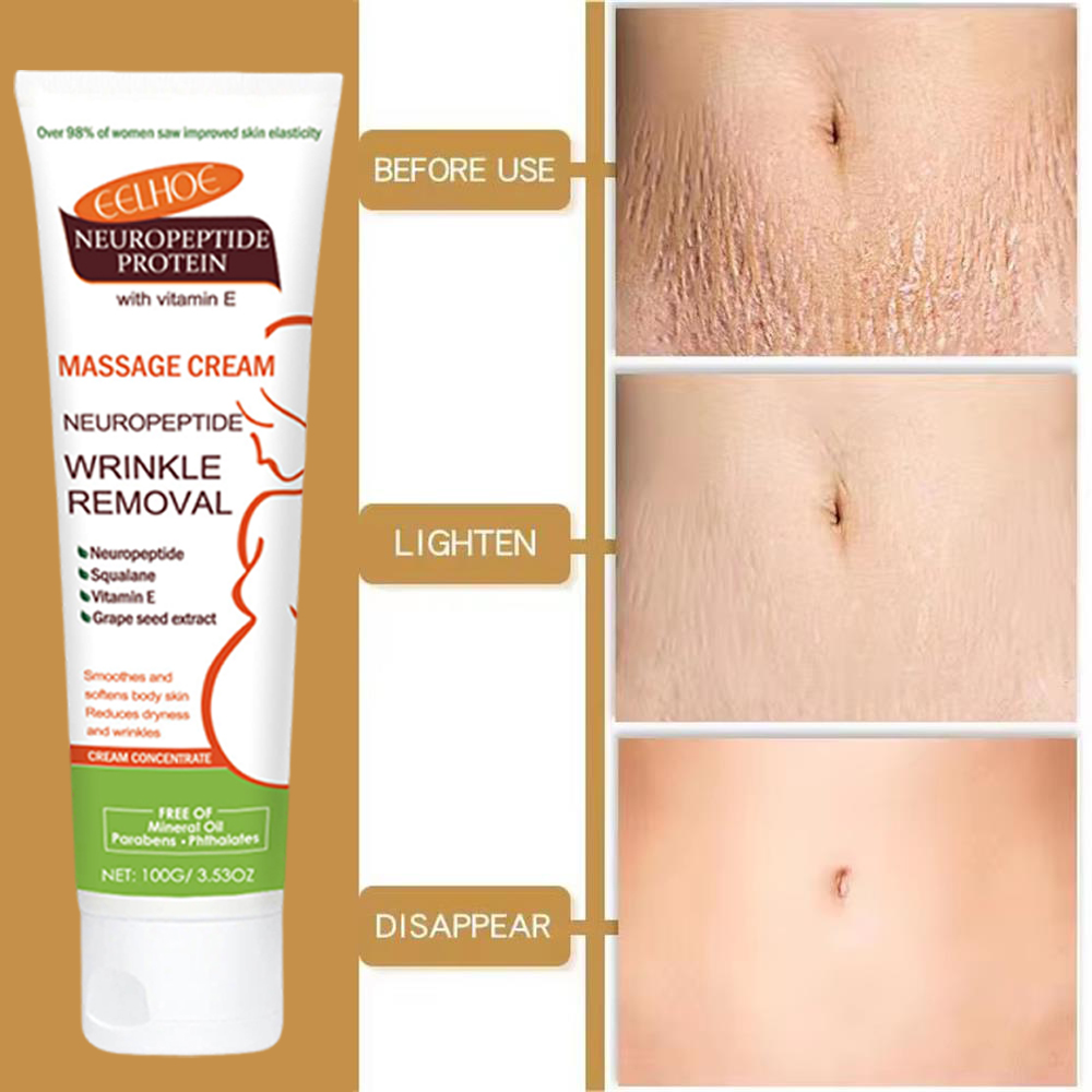 100g Stretch Marks Permanent R - Teeth Whitening Pregnancy recension och pris